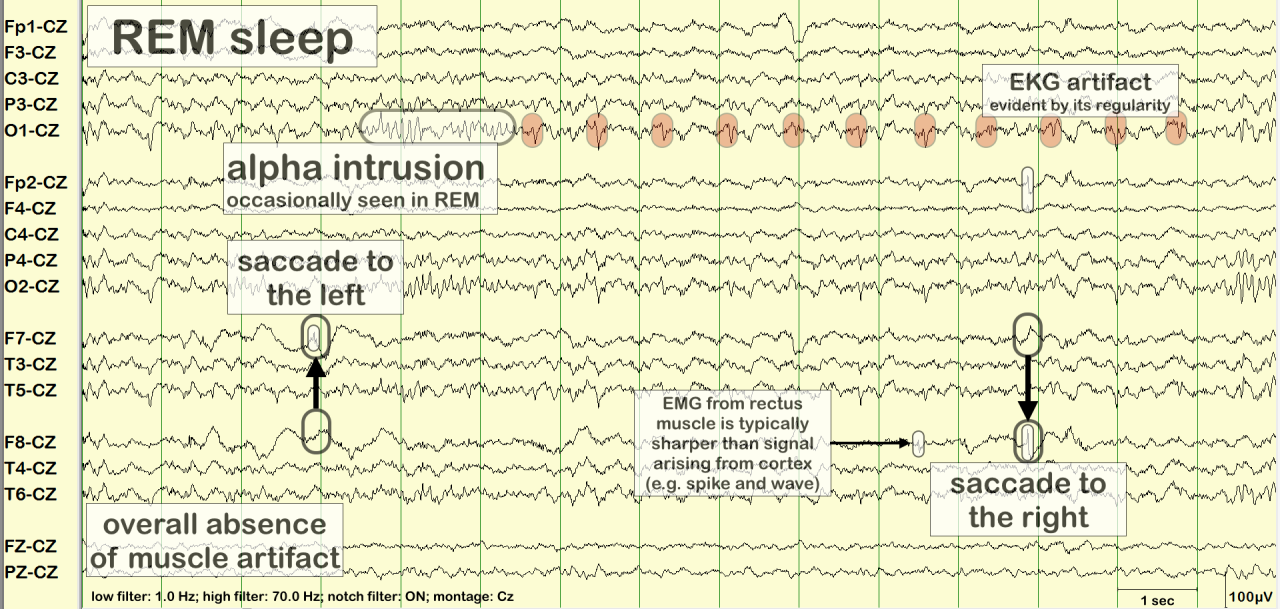 rapid eye movement (REM) sleep